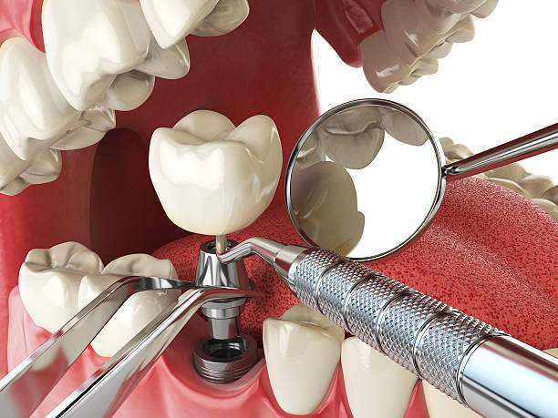 Best Emergency Wisdom Teeth Removal in Boonville, IN